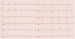 Abb. 2: EKG