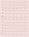 Abb. 5: EKG