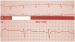 Abb. 1: EKG