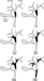 Aktuelles Bild - Abb. 1: Bismuth-Klassifikation - Hiläre Cholangiokarzinome