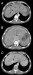 Abb. 1: Budd-Chiari-Syndrom