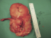 Abb. 2: Tumor - Appendix