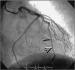 Abb. 3: Arteria coronaria sinistra - Stent