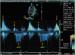Aktuelles Bild - Abb. 2: Transmitrale CW-Dopplerregistrierung