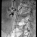 Abb. 3: Embolus - Passage