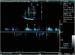Abb. 4: Transmitrales CW-Dopplerregistrierung