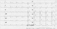 Abbildung 1: Mobiler Thrombus in der RCA bei NSTEMI