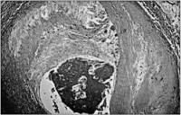 Abbildung 2: Akute Koronarsyndrome - Thrombusbildung - Plättchenaggregation