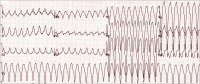 Abbildung 1: EKG