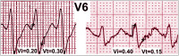 Abbildung 8: QRS-Komplex