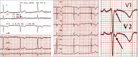 Abbildung 17: QRS-Komplex