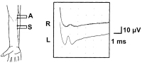 Abbildung 2: N. atebrachii medialis
