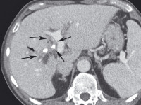 Abbildung 1a: Hypodenser Tumor