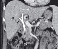 Abbildung 1b: Bilaterale Gallengangstents