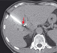 Abbildung 2: Tumor