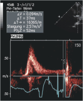 Abbildung 4: Gepulster Doppler