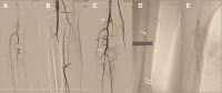 Abbildung 1a-e: Truncus tibiofibularis