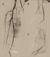 Abbildung 2a-c: Arteria tib. posterior