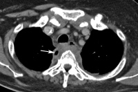 Abbildung 1c: Mediastinum