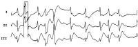 Abbildung 2: CPR-Verlauf - EKG