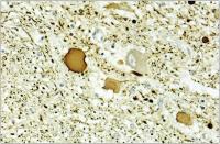 Abbildung 1c: ALS - Neuropathologie
