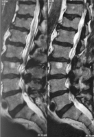 Abbildung 1b: Spinalkanalstenose
