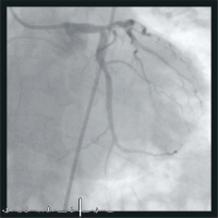 Abbildung 4: Stent