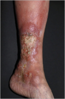 Abbildung 9: Lymphom