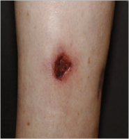 Abbildung 10: Pyoderma gangraenosum