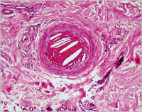 Abbildung 3: Cholesterinkristallembolie