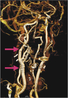 Abbildung 7: CT-Angiographie