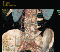 Abbildung 1: Aortenstentgraft