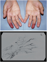 Abbildung 1: Raynaud-Phänomen