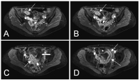 Abbildung 1a-d: Morbus Crohn