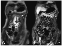 Abbildung 2: Colitis ulcerosa