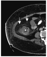 Abbildung 3: Colitis ulcerosa
