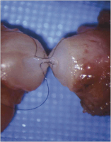 Abbildung 1: Vasovasostomie