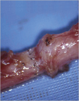 Abbildung 6: Vasovasostomie