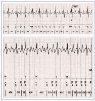 Abbildung 3: EKG