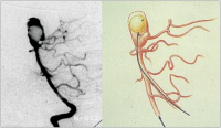 Abbildung 2: Aneurysma