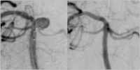 Abbildung 3: Aneurysma