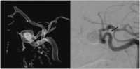Abbildung 4: Aneurysma