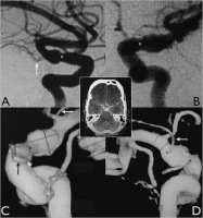 Abbildung 1a-d: Arteria carotis - Aneurysma