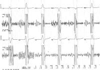 Abbildung 4: QRS-Komplex - Signalmittelung