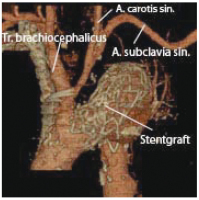 Abbildung 1: Stentgraft