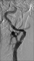Abbildung 6: Angiographie - Stentimplantation