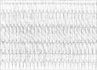 Abbildung 1: EKG