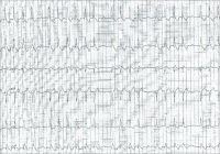 Abbildung 2: EKG