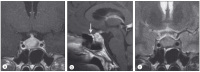 Abbildung 1a-c: Lymphozytäre Adenohypophysitis