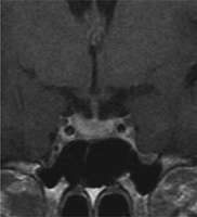 Abbildung 3: Lymphozytäre Adenohypophysitis